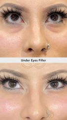 Acido hilauronico (Under Eyes Filler) - Vive Spa
