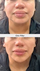 Acido hilauronico (Chin Filler) - Vive Spa