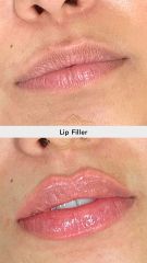 Aumento de labios, before & after - Vive Spa