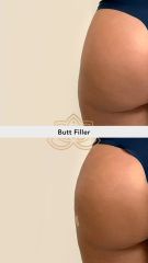 Acido hilauronico (Butt Filler) before & after - Vive Spa
