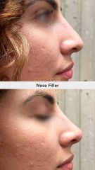 Acido hilauronico (Nose Filler) before & after - Vive Spa Médico