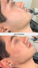Acido hilauronico (Jaw Contour) - Vive Spa Médico