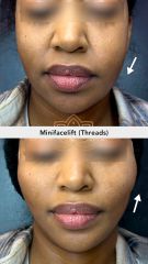 Hilos tensores (Minifacelift) before & after - Vive Spa Médico
