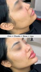 Acido hilauronico (Chin+Cheeks+Nose+Lips) - Vive Spa Médico