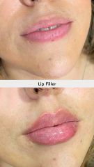 Aumento de labios (Lip Filler)- Vive Spa Médico