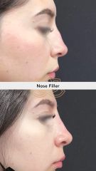 Acido hialuronico (Nose filler) before & after - Vive Spa Med