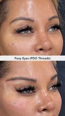 Hilos tensores (Foxy eyes - PDO Threads) before & after - Vive Spa Med