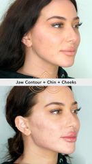 Acido hialuronico (Jaw Contour+ Chin+ Cheeks) before & after - Vive Spa Med