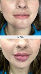 Acido hialuronico (Lip Filler) before & after - Vive Spa Med