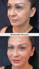 Hilos tensores (Minifacelift- threads) before & after - Vive Spa Med