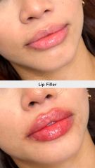 Aumento de labios (Lip Filler)  - Vive Spa Médico