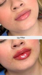 Aumento de labios (Lip Filler) Before & After- Vive Spa Med