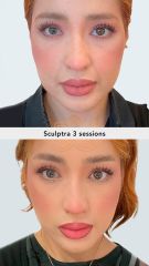 Acido hilauronico (Sculptra 3 sessions) before & after- Vive Spa Med
