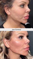 Acido hilauronico (Jaw Contour) - Vive Plastic Surgery