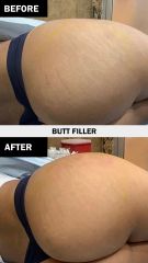 Acido hilauronico (Butt Filler) before & after - Vive Spa Med