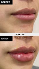 Aumento de labios (Lip Filler) before & after - Vive Spa Med