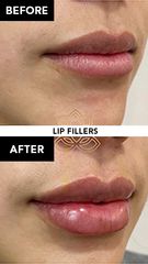 Aumento de labios, Before & After- Vive Spa Med