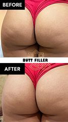 Acido hialuronico (butt filler) before & after - Vive Spa Med