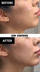 Acido hilauronico (Jaw Contour) before & after - Vive Spa med