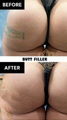 Acido hialuronico (butt filler) before & after - Vive Spa Med