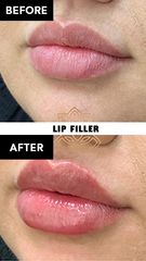Aumento de labios (Lip Filler) before & after - Vive Spa Med