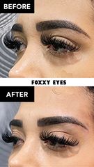 Hilos Tensores (Foxxy Eyes) before & after - Vive Spa Med