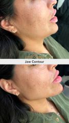 Acido hilauronico (Jaw Contour) before & after - Vive Spa Med