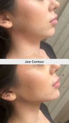 Acido hilauronico (Jaw Contour) before & after - Vive Spa Med
