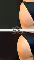 Acido hialuronico (butt filler) before & after - Vive Med Spa