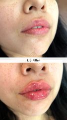 Aumento de labios (Lip Filler) - Vive Plastic Surgery