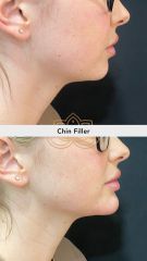 Aumento de labios (Chin Filler) - Vive Spa Med