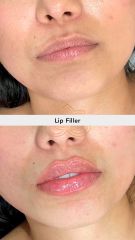 Aumento de labios (Lip Filler) - Vive Spa Med