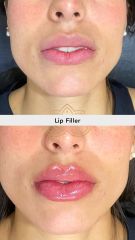 Aumento de labios (Lip Filler) - Vive Spa Med