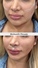 Hilos tensores (Minifacelift - threads) - Vive Spa Med