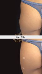 Acido hialuronico (butt filler)  - Vive Spa Med