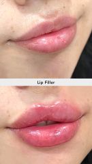 Aumento de labios (Lip Filler) - Vive Spa Med