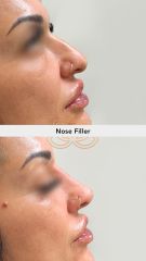 Acido hialuronico (Nose Filler) - Vive Spa Med