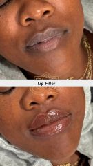 Aumento de labios (Lip Filler) - Vive Spa Med