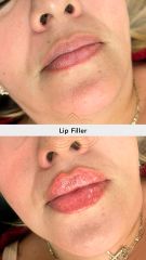 Aumento de labios (Lip Filler) - Vive Spa Med