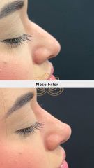 Acido hialuronico (Nose Filler) - Vive Spa Med