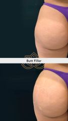 Acido hialuronico (butt filler) - Vive Spa Med