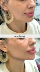 Acido hilauronico (Jaw Contour) - Vive Spa Med