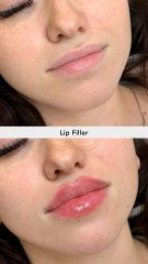 Aumento de labios (Lip Filler) - Vive Spa Med