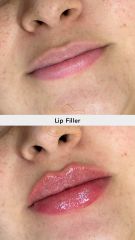 Aumento de labios (Lip Filler) - Vive Spa Med