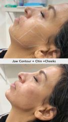 Acido hilauronico (Jaw Contour), Chin y Cheeks - Vive Spa Med