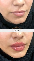 Aumento de labios (Lip Filler) - Vive Spa Med