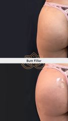 Acido hialuronico (butt filler) - Vive Spa Med