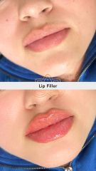 Aumento de labios (Lip Filler) - Vive Spa Med