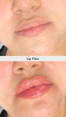 Aumento de labios (Lip Filler) - Vive Spa Med