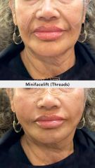 Hilos tensores (Minifacelift - threads) - Vive Spa Med